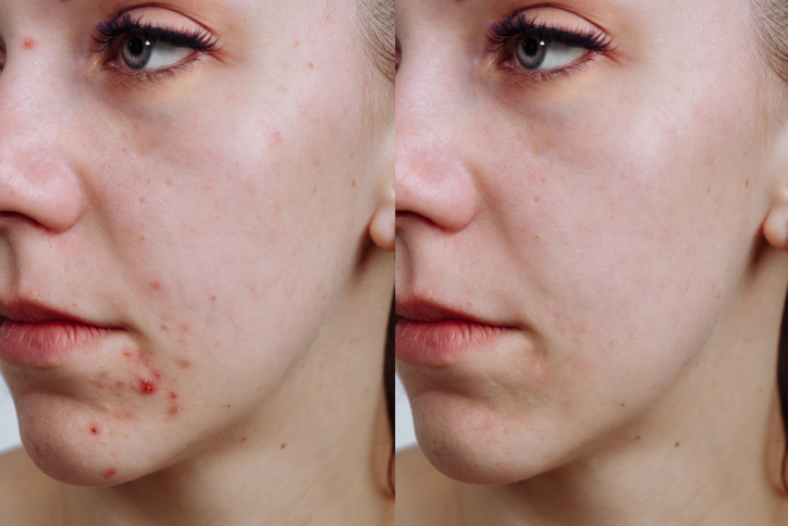 Get rid of acne with Joyome