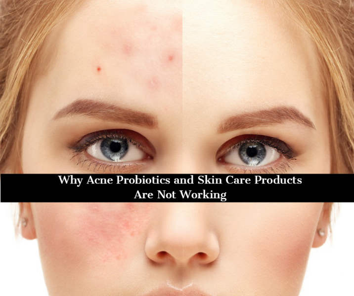 Why Acne Probiotics and Skin Creams Aren’t Working